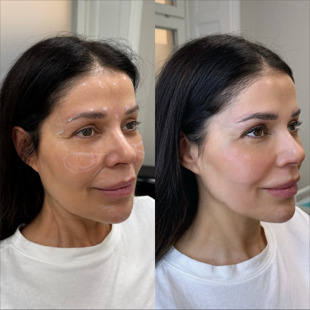 botox