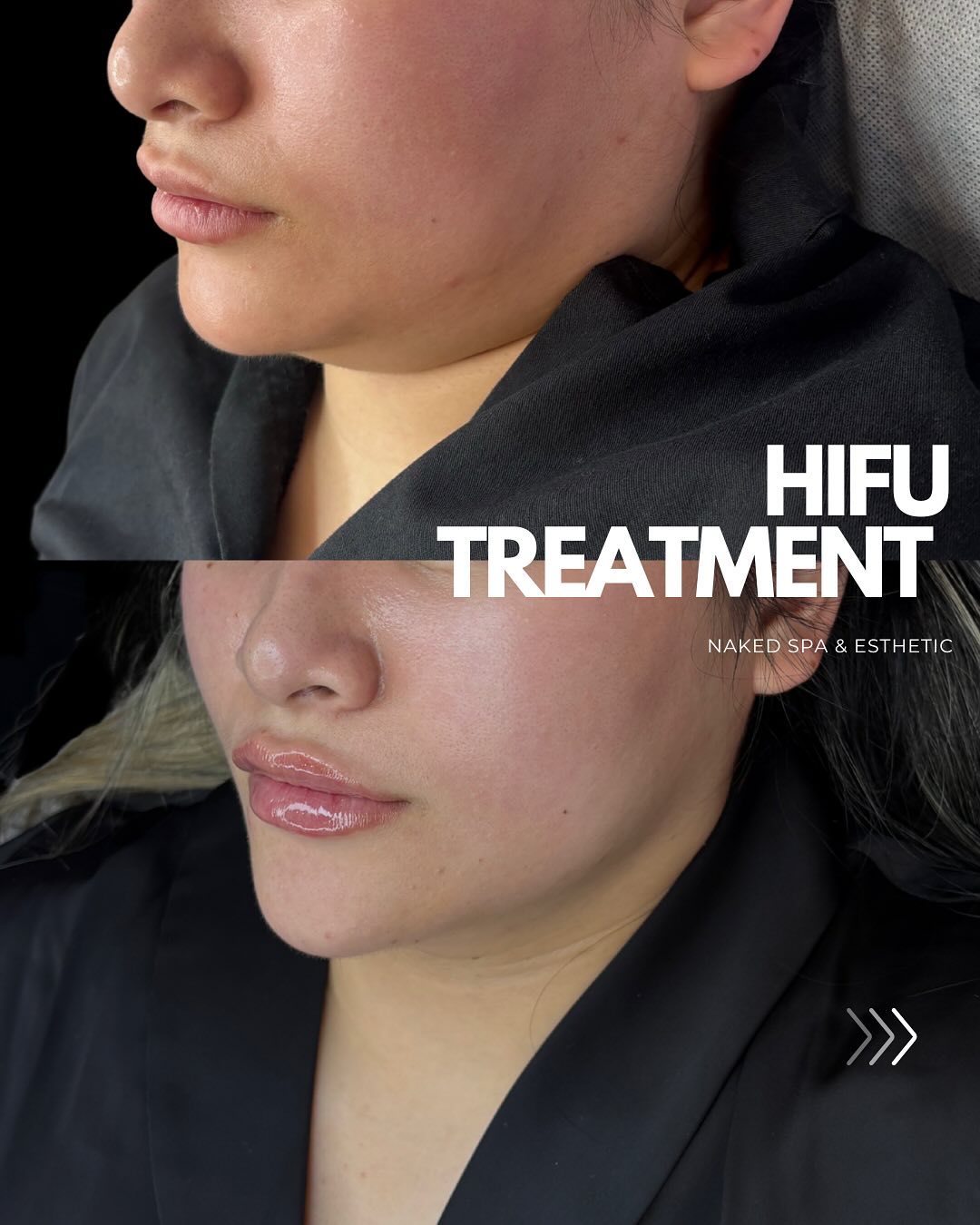 hifu
